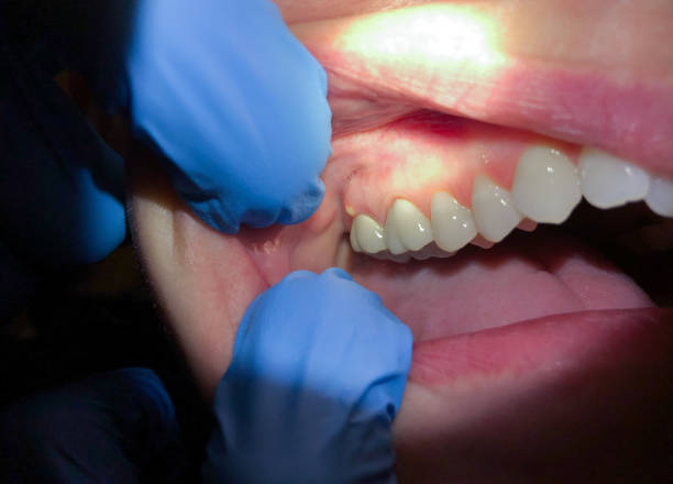 Best Knocked-Out Tooth (Avulsed Tooth) Treatment in Margate City, NJ